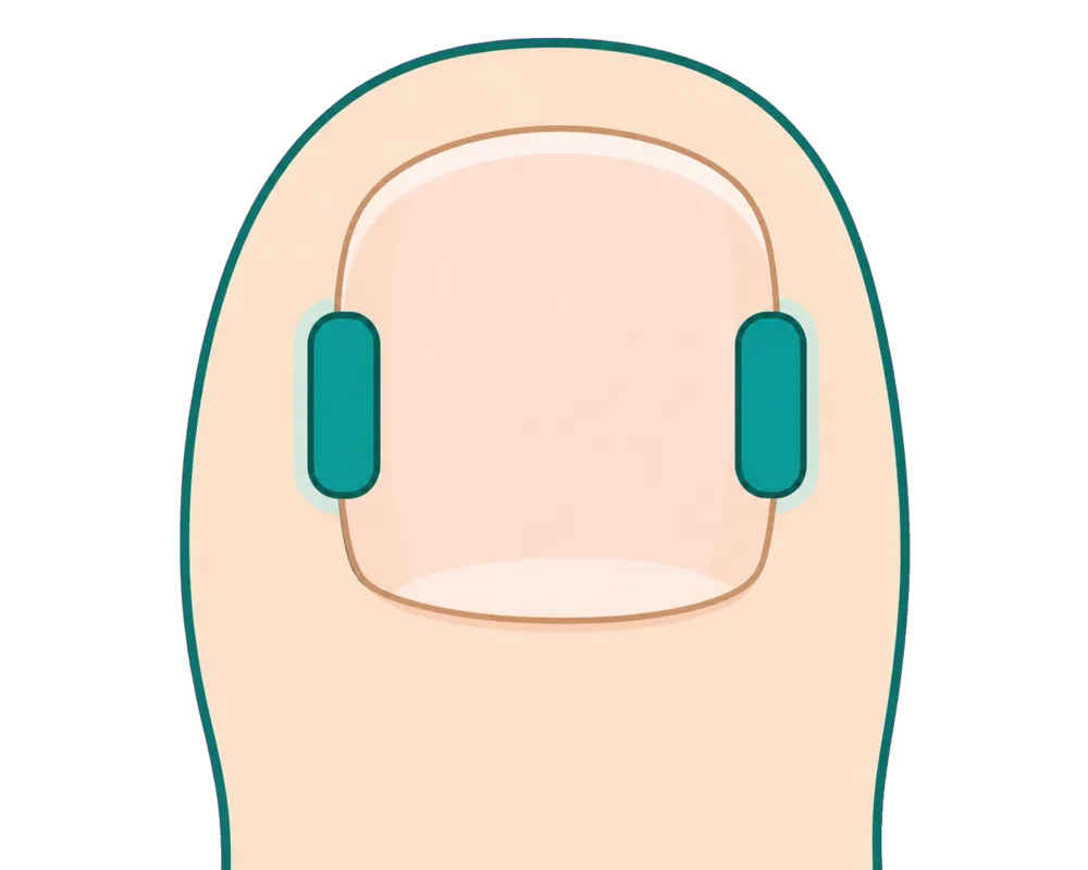 同じ親指の爪の両側を補正するイメージ