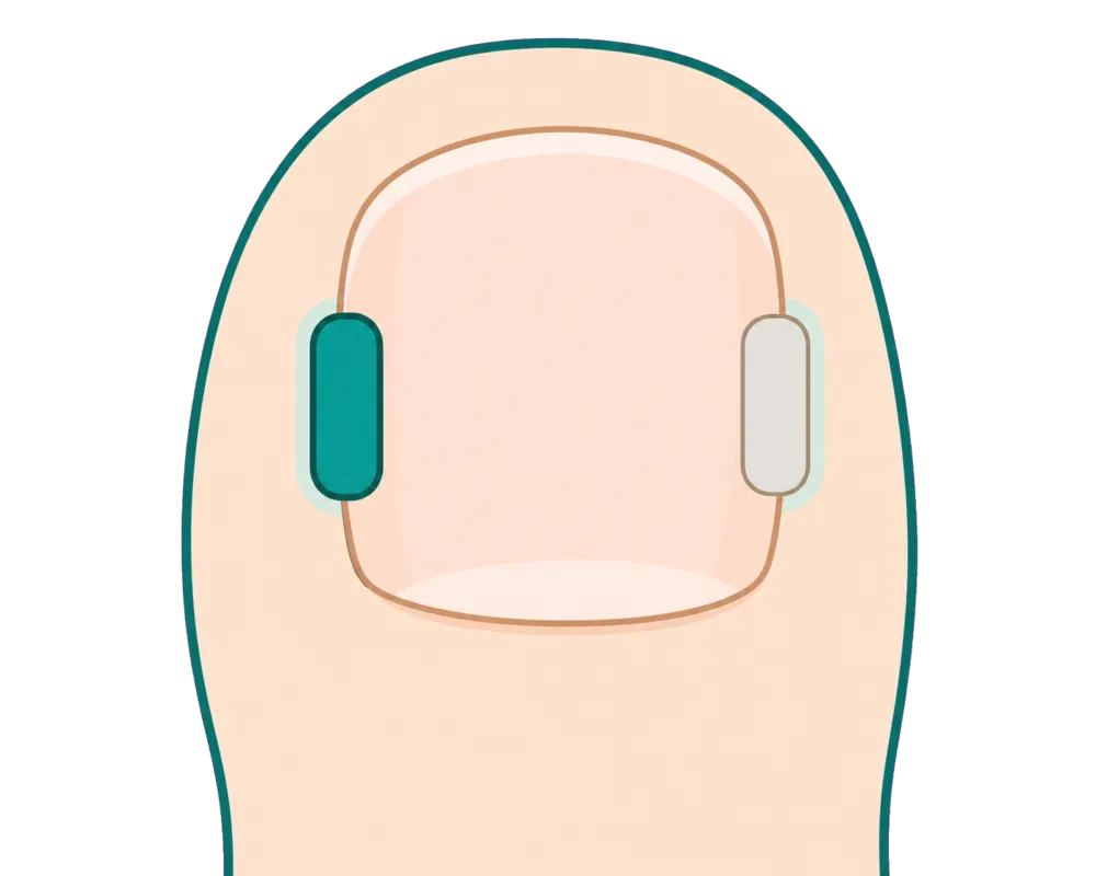 同じ親指の爪の片側のみを補正するイメージ